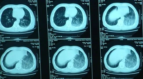 春日體檢，警惕肺纖維化這個 “呼吸刺客”